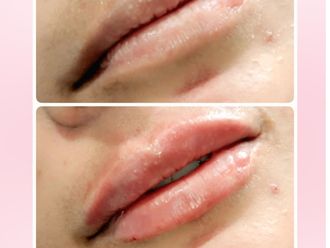 Aumento de labios antes y después - 876840