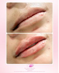 Aumento de Labios - Dra. Lena Ferreiro