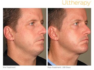 Antes y después de Lifting Facial No Quirúrgico. 