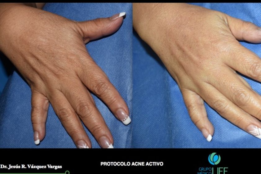 Peeling antes y después - 624984
