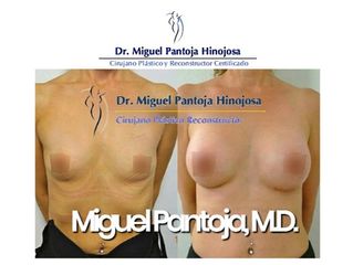 Aumento de busto - Dr. Miguel Pantoja Hinojosa