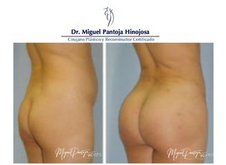 Gluteoplastia - Dr. Miguel Pantoja Hinojosa