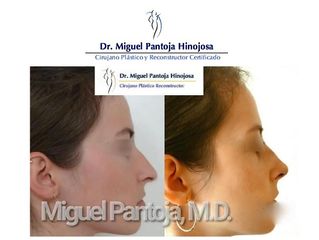 Rinoplastia - Dr. Miguel Pantoja Hinojosa