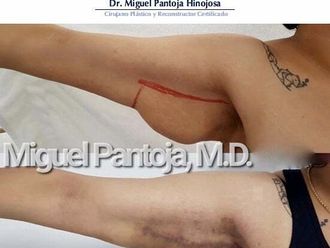 Braquioplastia antes y después - 791908