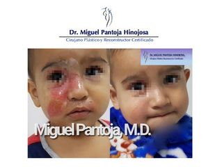 Cirugía Reconstructiva de Niños Quemados - Dr. Miguel Pantoja Hinojosa