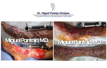 Cirugía Reconstructiva para Salvamento de Extremidades - Dr. Miguel Pantoja Hinojosa