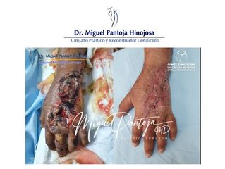 Cirugía de Salvamento de Mano - Dr. Miguel Pantoja Hinojosa