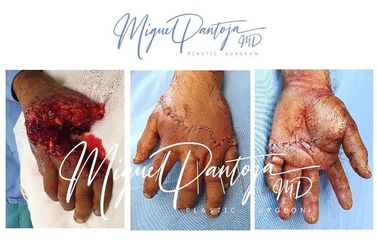 Reimplante Microvascular de Manos Amputadas - Dr. Miguel Pantoja Hinojosa