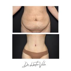 Liposucción HD - Dra. Stella Villarreal & Dr. Héctor Vela