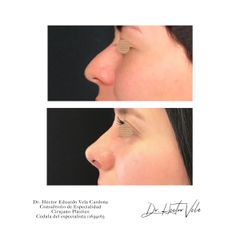 Antes y después de Rinoplastia