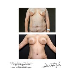 Antes y después de Mommy makeover 