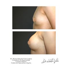 Antes y después de Aumento de busto