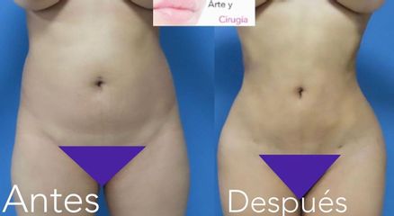 Liposucción - Dr. Sigfrido García Román