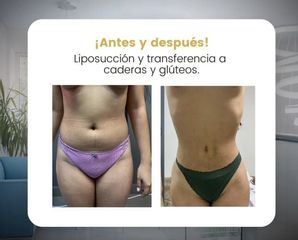 Liposucción - Dr. Sigfrido García Román