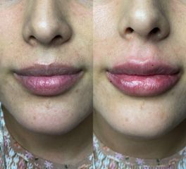 Aumento de labios - Dr. Sigfrido García Román