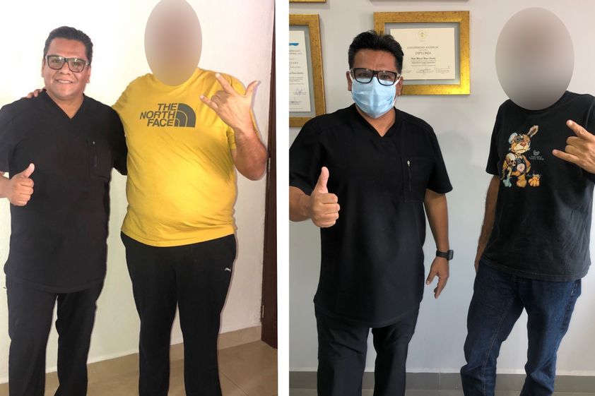Bypass Gástrico antes y después - 856316