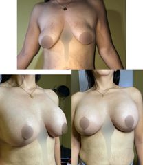 Mastopexia - Dr. Sigfrido García Román