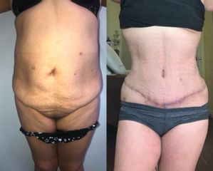 Abdominoplastia - Dr. Sigfrido García Román