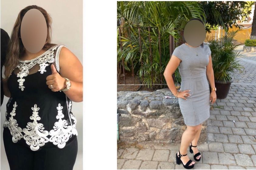 Bypass Gástrico antes y después - 856322