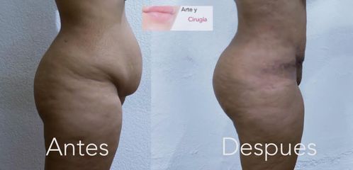 Abdominoplastia - Dr. Sigfrido García Román