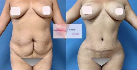 Abdominoplastia - Dr. Sigfrido García Román