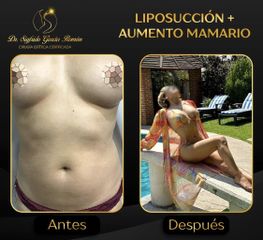 Liposucción - Dr. Sigfrido García Román