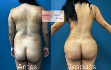Liposuccion y Gluteoplastia - Dr. Sigfrido García Román