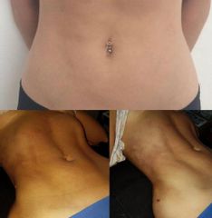 liposucción HD - Dr. Sigfrido García Román