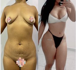 Liposucción - Dr. Sigfrido García Román