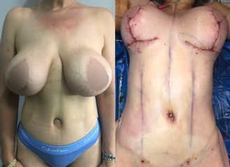 Mommy makeover - Dr. Sigfrido García Román