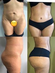 Lipoabdominoplastia - Dr. Sigfrido García Román