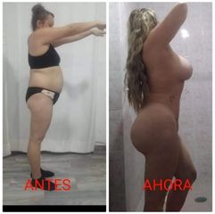 Lipoabdominoplastia - Trasplante de cabello - Dr. Sigfrido García Román