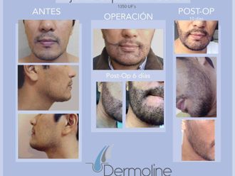 Trasplante de cabello antes y después - 856492