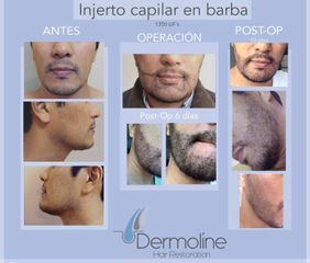 Injerto capilar en barba - Dr. Sigfrido García Román
