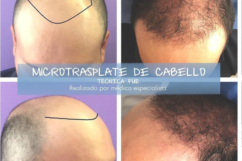 Trasplante de cabello antes y después - 856493