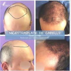 Trasplante de cabello - Dr. Sigfrido García Román