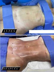 Liposucción HD - Dr. Sigfrido García Román