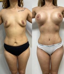 Mommy makeover - Dr. Sigfrido García Román
