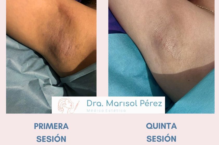 Manchas en la Piel antes y después - 868902