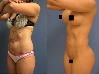 Antes y después de Lipoescultura