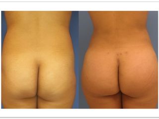 Antes y después de Lipoescultura