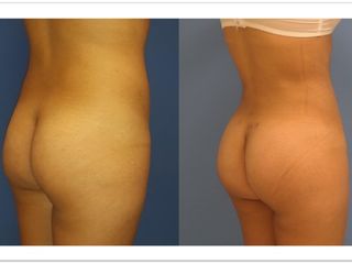 Antes y después de  Lipoescultura