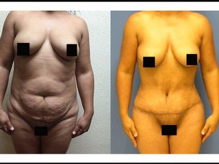 Antes y después de Abdominoplastia