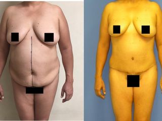 Antes y después de  Abdominoplastia