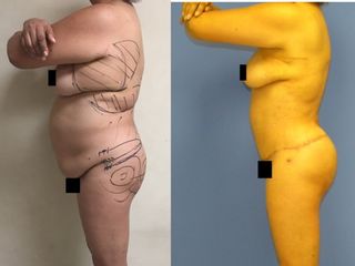 Antes y después de Abdominoplastia