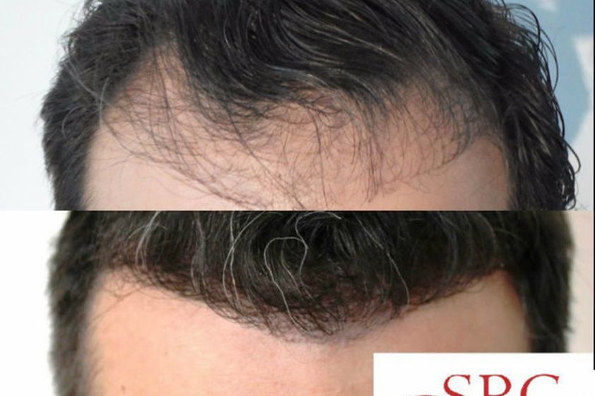 Alopecia antes y después - 606361