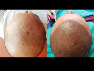 Antes y después de micro pigmentación capilar
