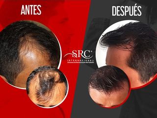 Antes y después tratamiento para Alopecia