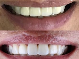 Implantes Dentales - 641407