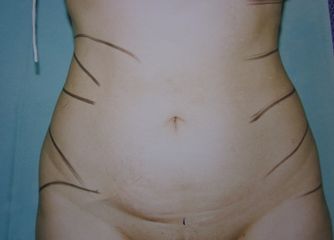 Lipo